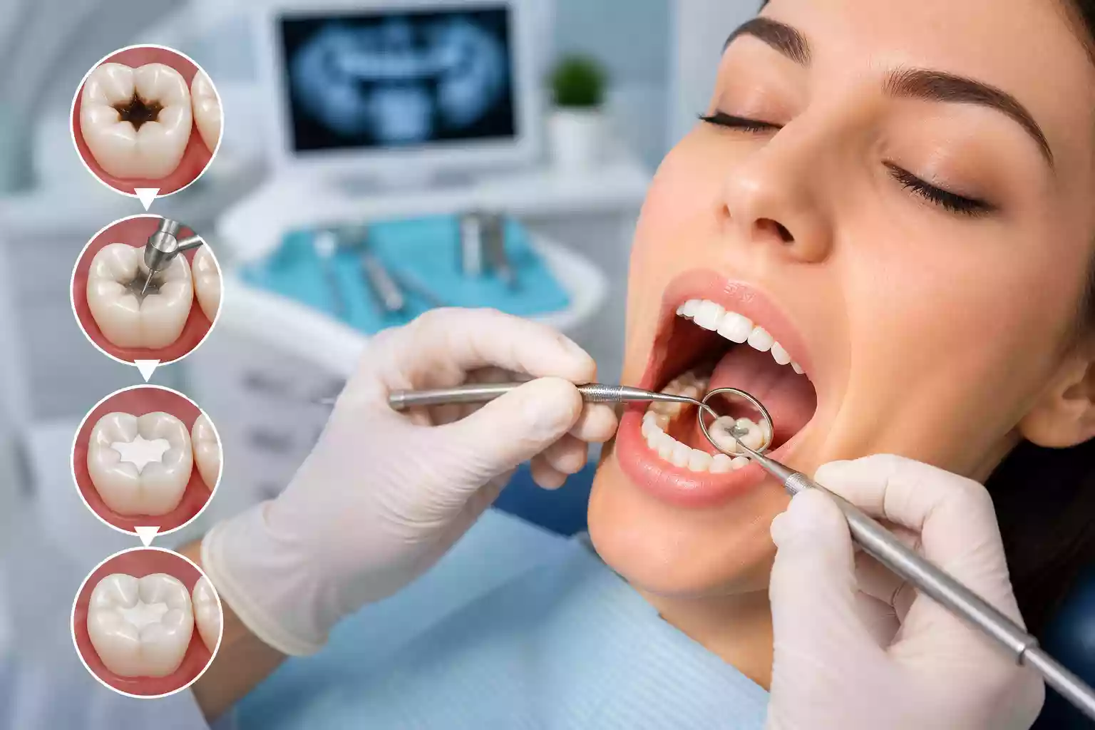 Milas Filling Treatments (Conservative) – Modern Solutions for Decayed and Damaged Teeth