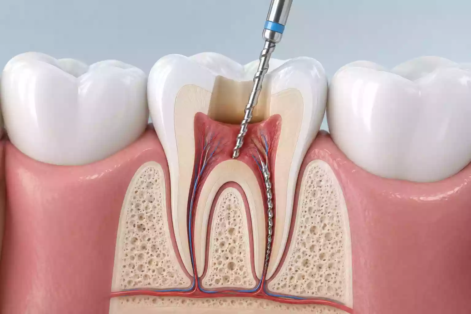 Milas Root Canal Treatment